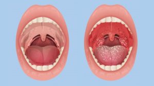throat cobblestone tonsil
